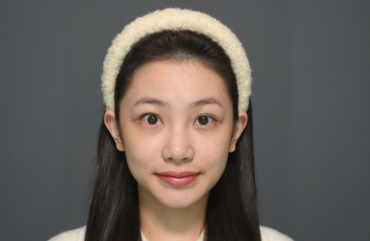 術前困擾：美顏相機也遮不住的「憔悴陰影」｜見證案例-Nikki